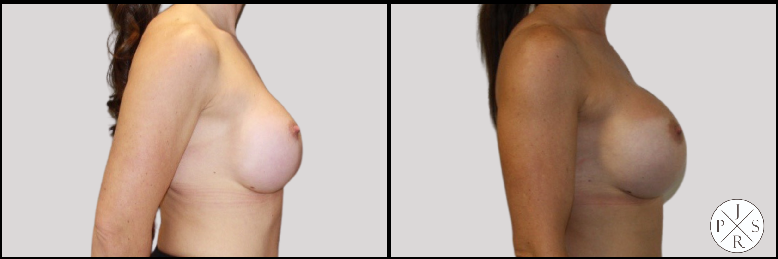 Breast Revision Before & After Image